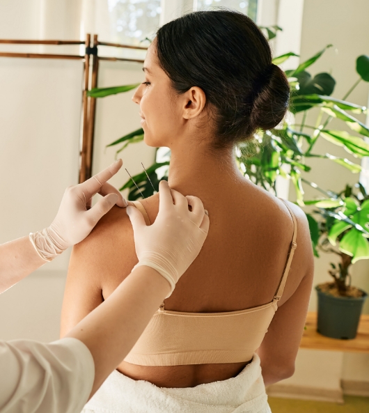 acupuncture